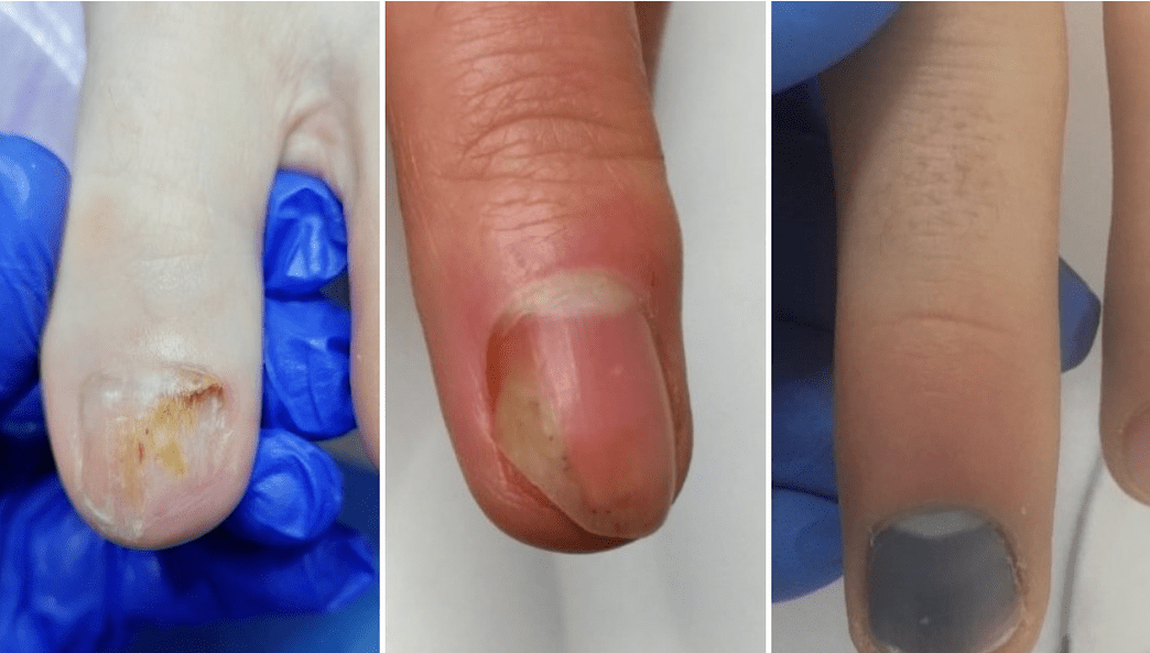 cum să restabiliți unghiile de la picioare după ciupercă